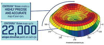 Illustration showing topographic image of an eye