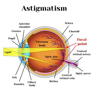 Illustration describing various parts of the eye with Astigmatism
