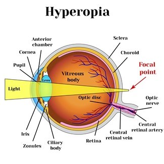 Illustration describing hyperopia