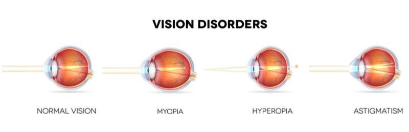 illustration showing the light beam on various eye disorders