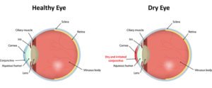 Illustration of a healthy eye and dry eye