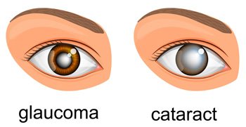 Illustration showing difference between Glaucoma and Cataract