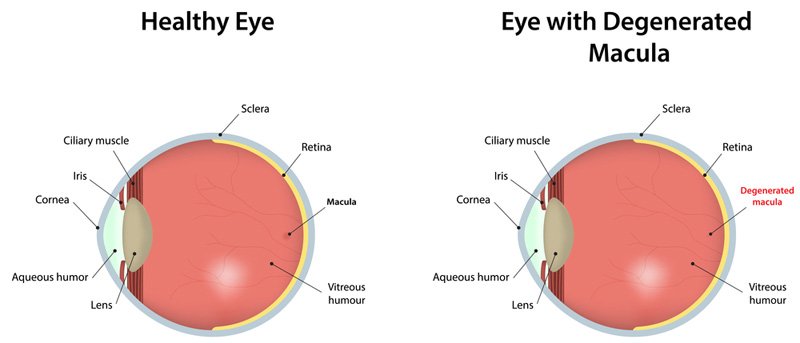Comparison between healthy eye and eye with AMD