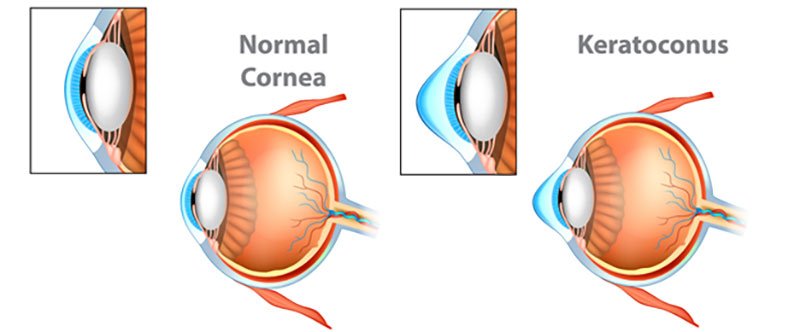 Comparison of normal cornea with Keratoconus