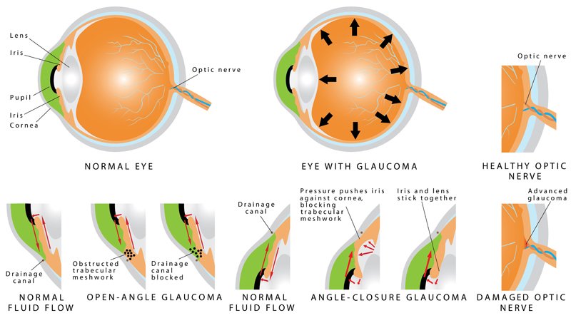 Illustration of normal eye and eye with various types of Glaucoma