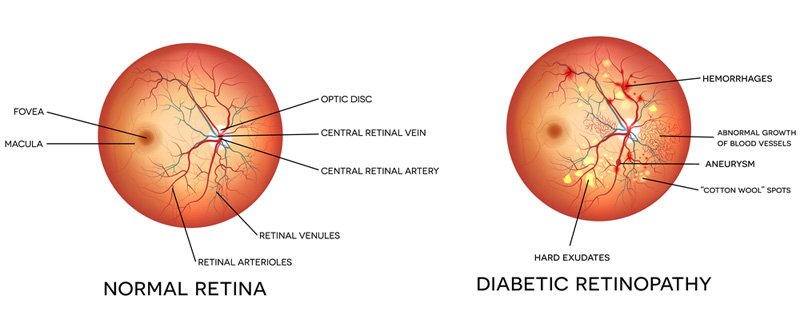 Illustration comparison of normal retina and diabetic retinopathy