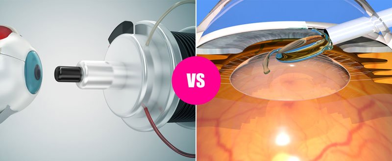 Ongemak moord Beweging Difference Between LASIK and Intraocular Lenses (IOL) Implant