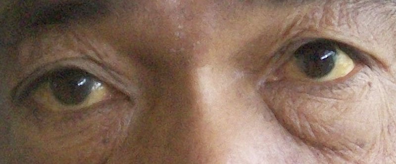 Yellow eyes of an elderly due to Jaundice