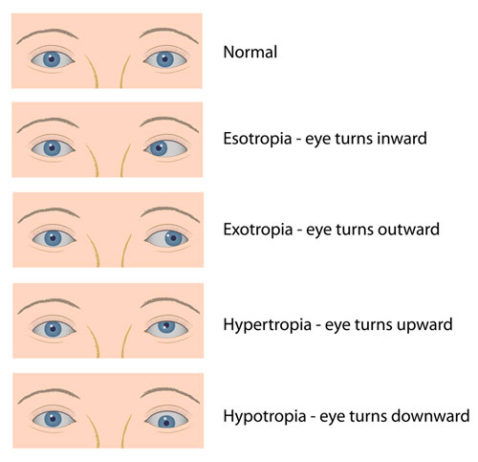 Squint Eye Treatment for Babies & Children in Delhi