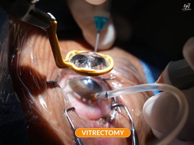 Vitrectomy
