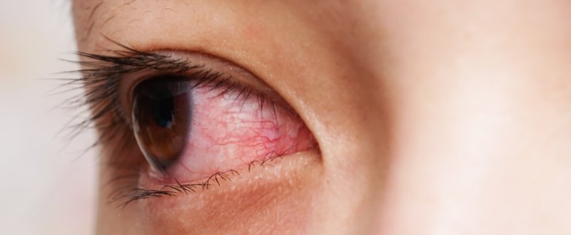 Close up of a woman's red eye
